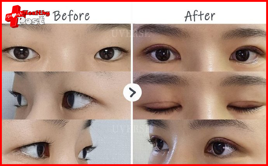 Blepharoplasty Before and After