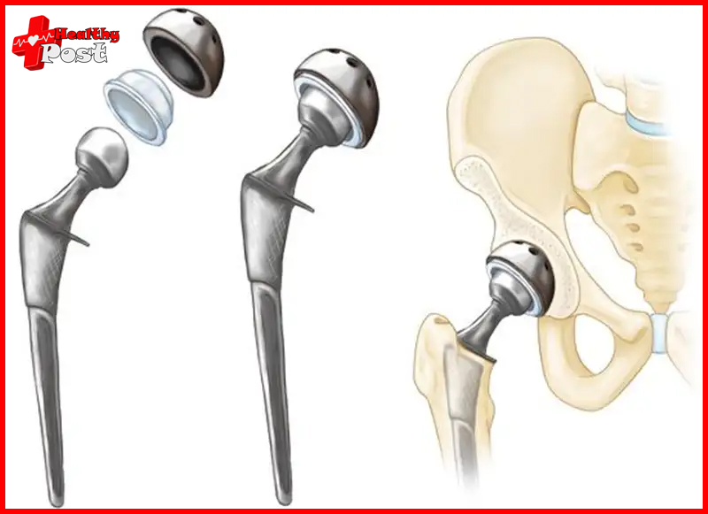 Hip replacement surgery