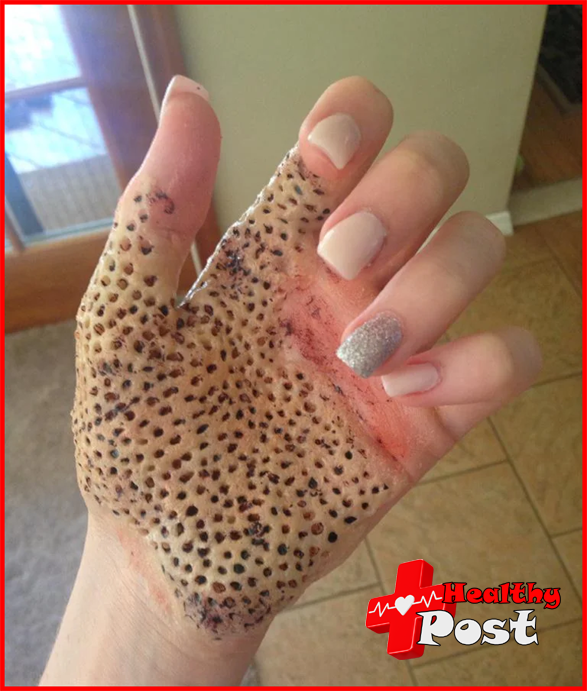 trypophobia