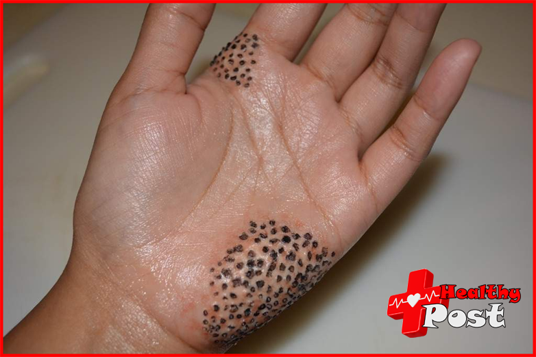 trypophobia