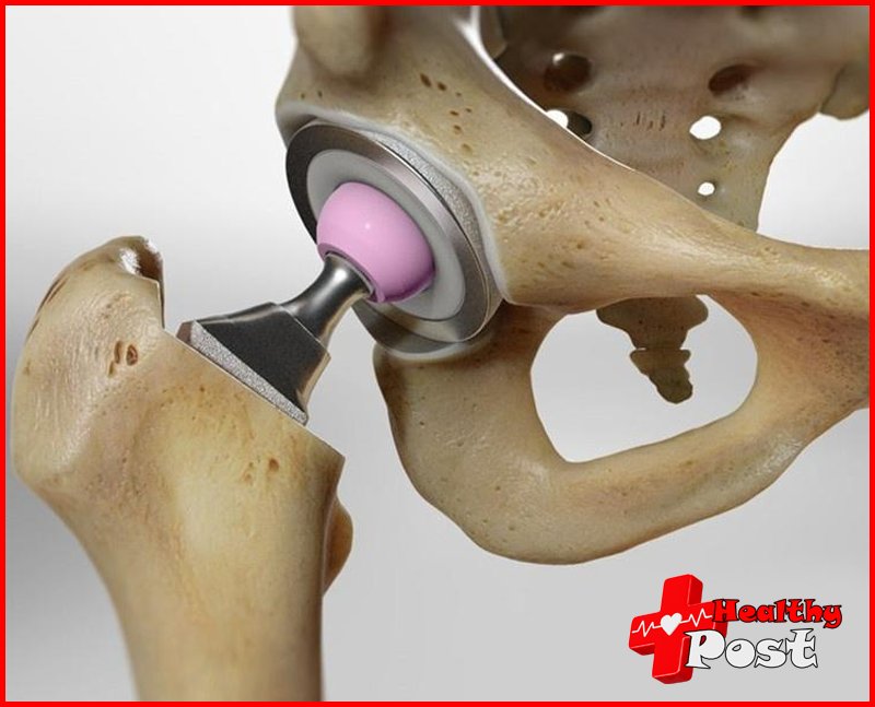 Hip replacement surgery