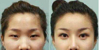 Blepharoplasty Before and After