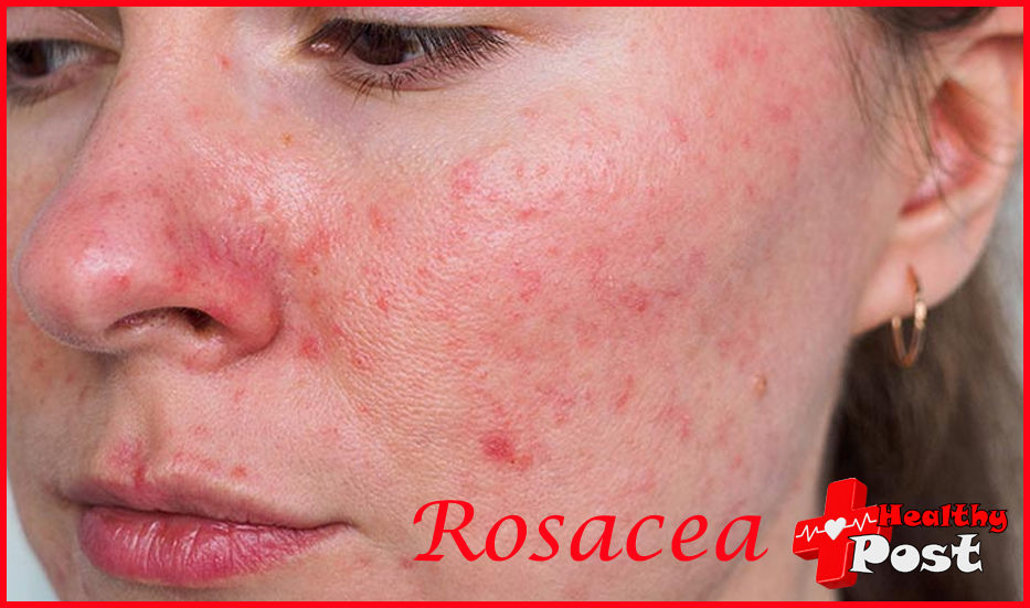 rosacea