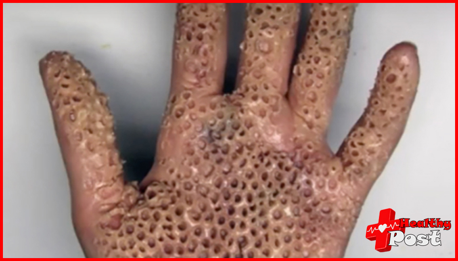 trypophobia