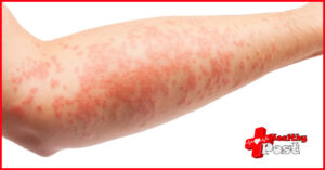 Eczema Symptoms