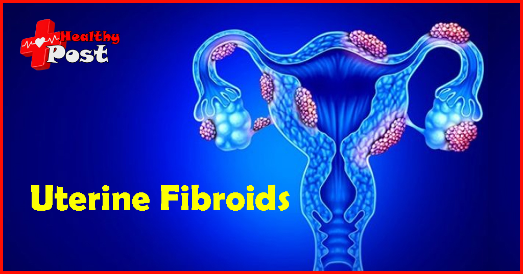 Uterine fibroids