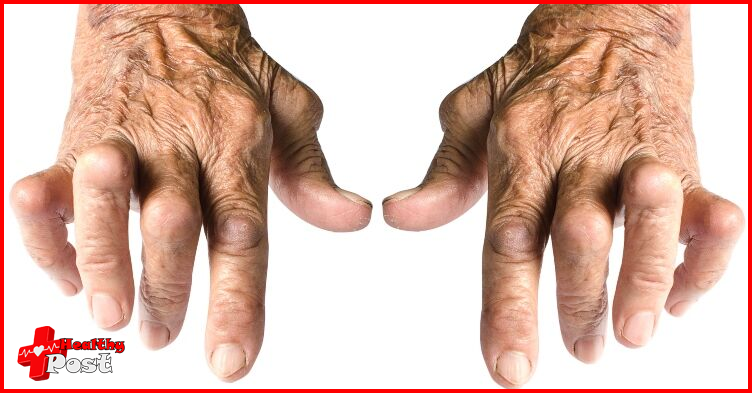 Rheumatoid Arthritis 