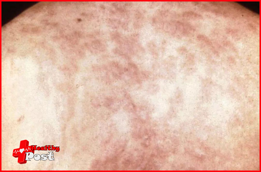 Syphilis Rash Crusts Over 69 pose risks for health, be careful to open your mouth