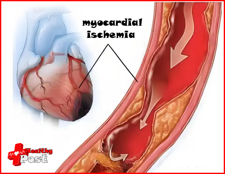 myocardial ischemia