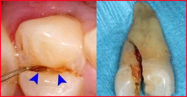 How to fix a broken tooth