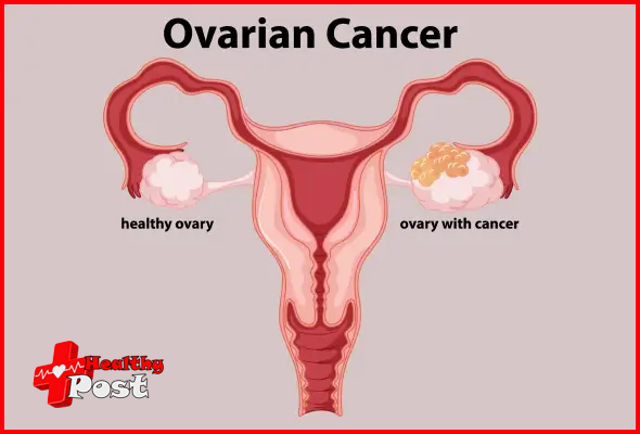 Ovarian Cancer