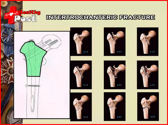 intertrochanteric fracture