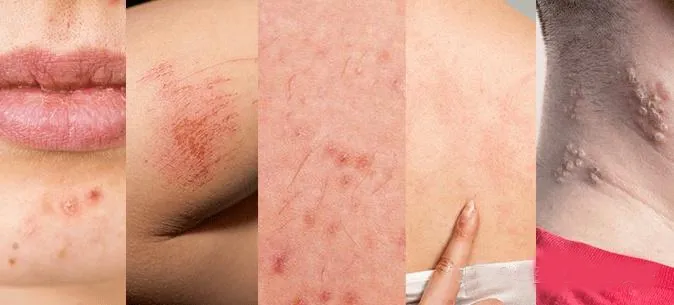 Eczema