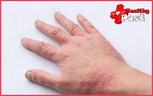 Eczema