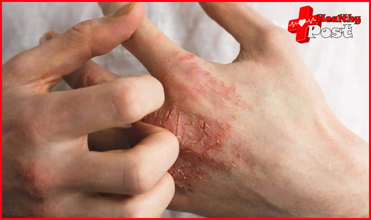 Eczema Symptoms