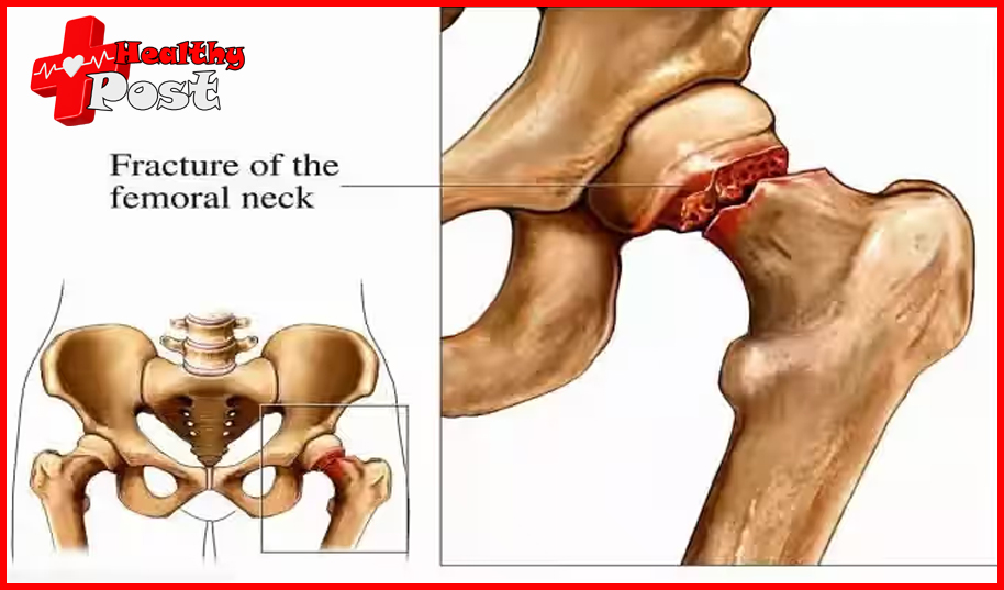 intertrochanteric fracture