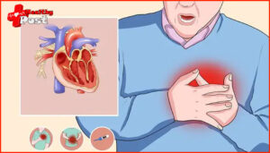 myocardial ischemia