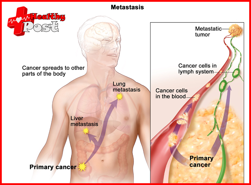 lung metastasis