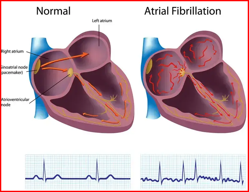 ICD 10 Atrial Fibrillation