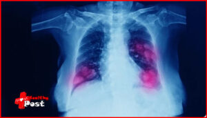 lung metastasis