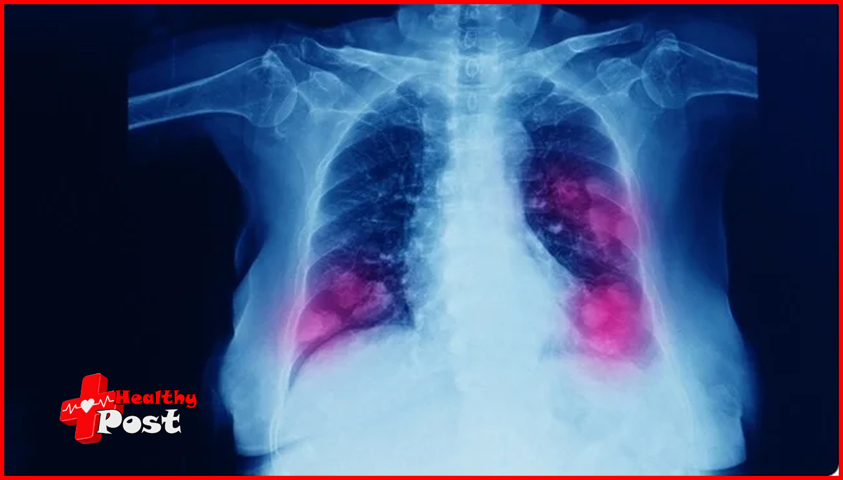 lung metastasis