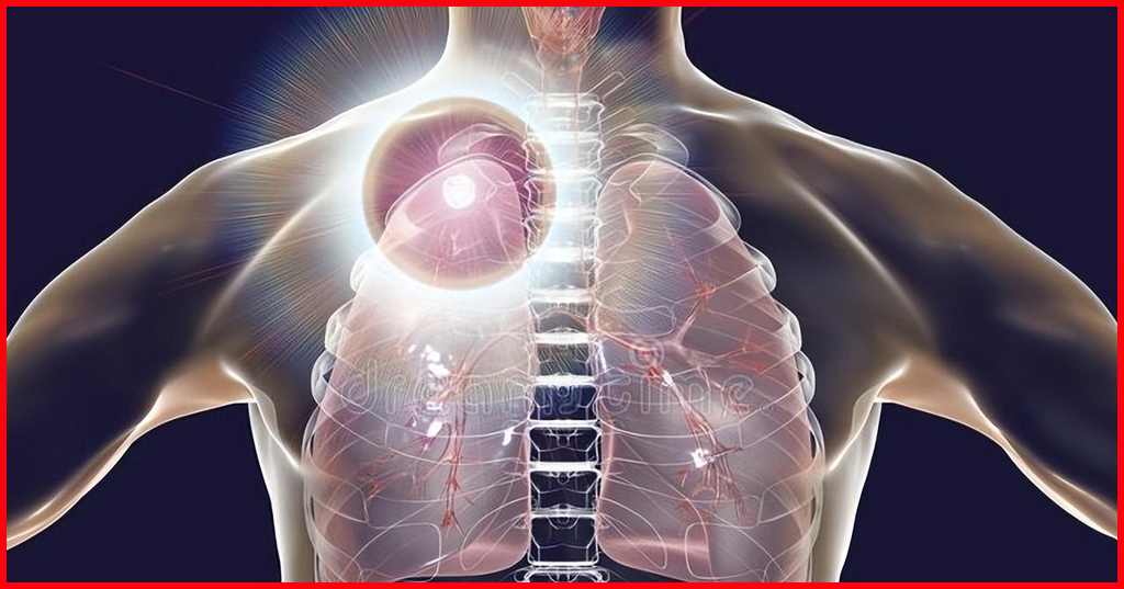 lung nodules