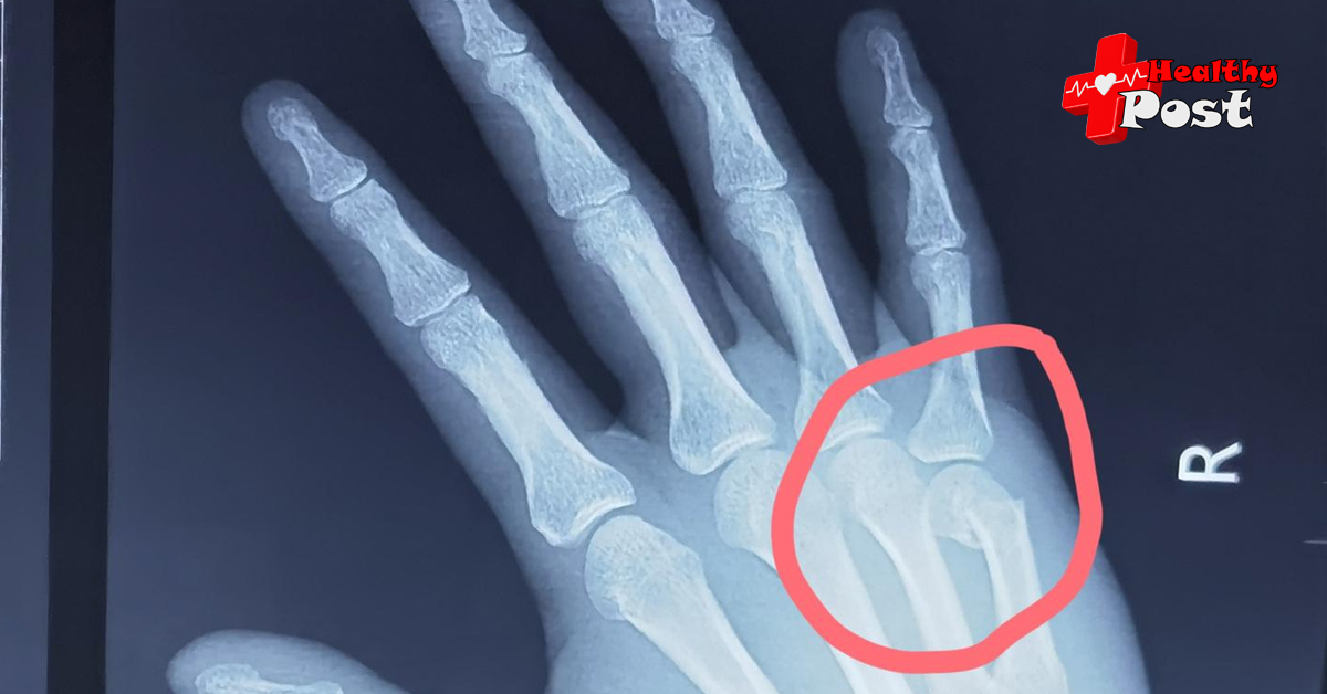 Metacarpal fracture