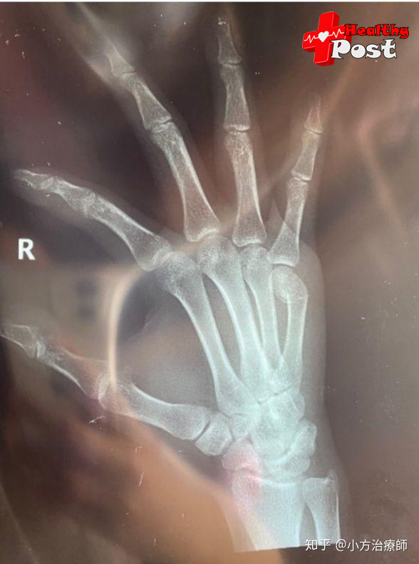 Metacarpal fracture X-ray