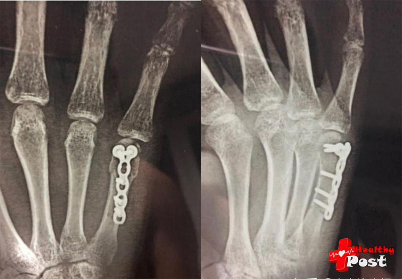 X-ray images after metacarpal internal fixation