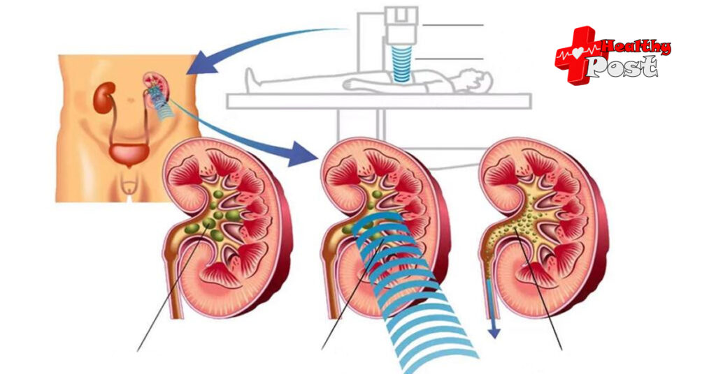 Medical illustration showing the location of kidney stones within the renal system and therapeutic sound wave alignment for stone fragmentation.