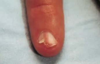 Nail Disease