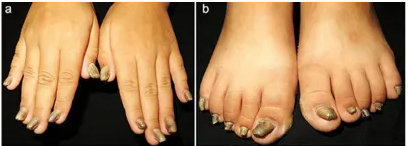 Nail Disease
