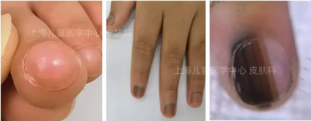 Nail disease in children: early manifestations and diagnostic recommendations 6 Nail disease in children