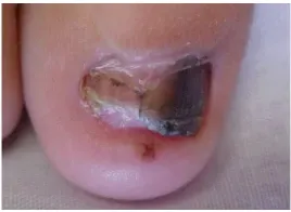 Nail disease in children: early manifestations and diagnostic recommendations 7 Nail disease in children early manifestations and diagnostic recommendations