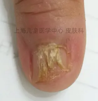 Nail disease in children: early manifestations and diagnostic recommendations 8 Nail disease in children early manifestations and diagnostic recommendations