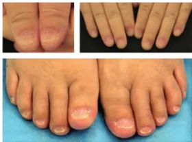 Nail disease in children: early manifestations and diagnostic recommendations 9 Nail disease in children early manifestations and diagnostic recommendations