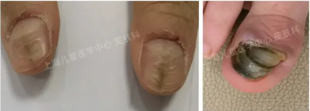 Nail disease in children: early manifestations and diagnostic recommendations 10 Nail disease in children early manifestations and diagnostic recommendations