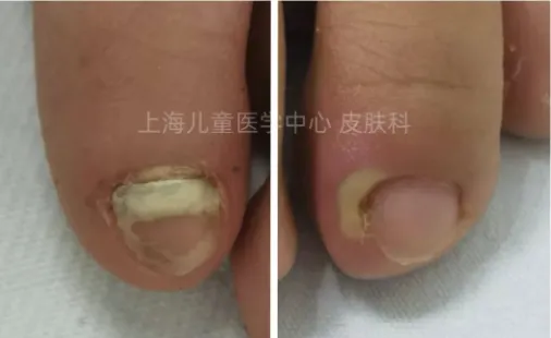 Nail disease in children: early manifestations and diagnostic recommendations 5 Nail disease in children