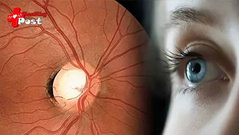 intraocular pressure