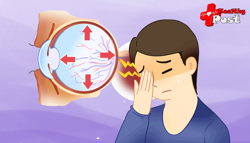 intraocular pressure