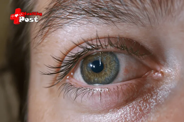 Exophthalmos