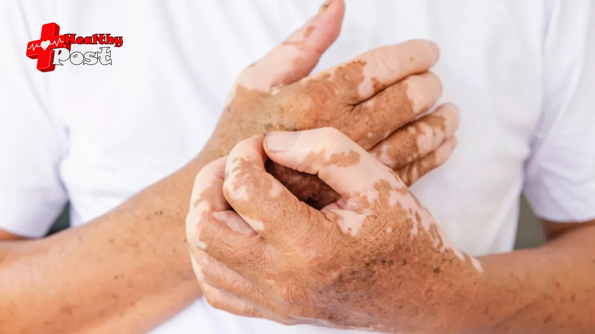 Vitiligo icd 10