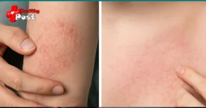 difference between eczema and heat rash