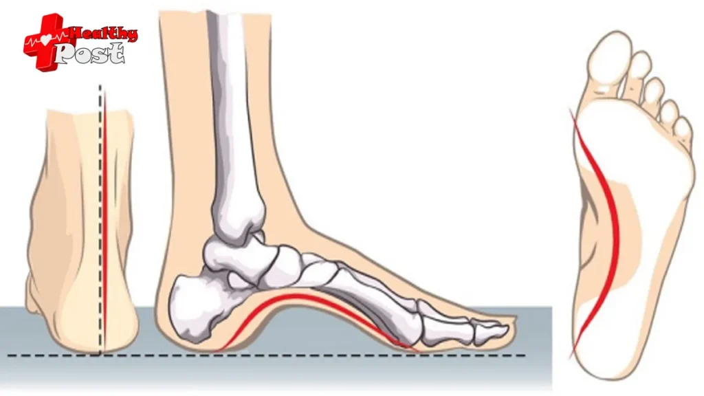 You can avoid flat feet, but you can’t avoid high arches! These few moves will teach you how to improve high arches High Arches