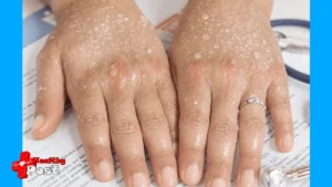 Hyperhidrosis icd 10