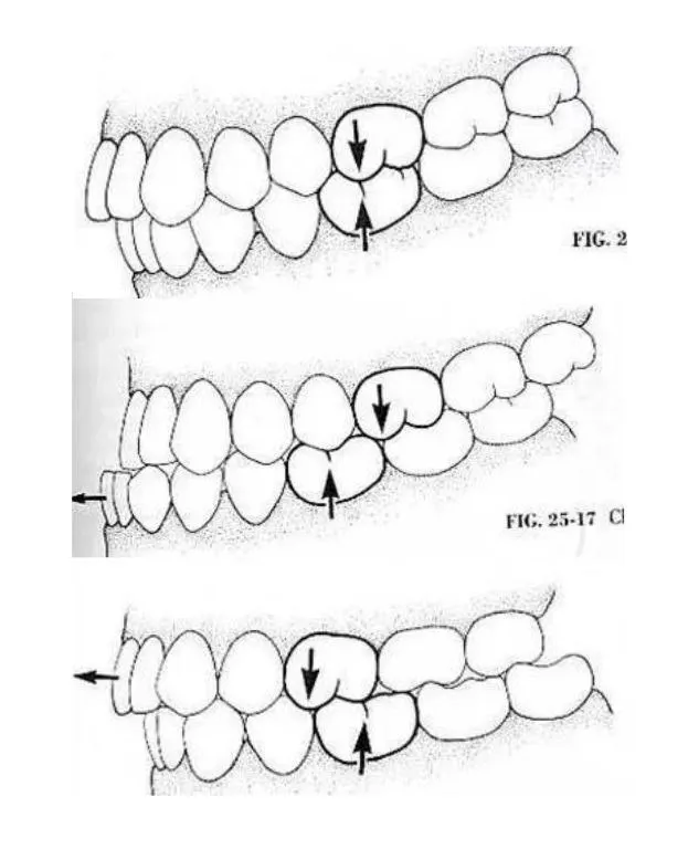 Orthodontic Treatment