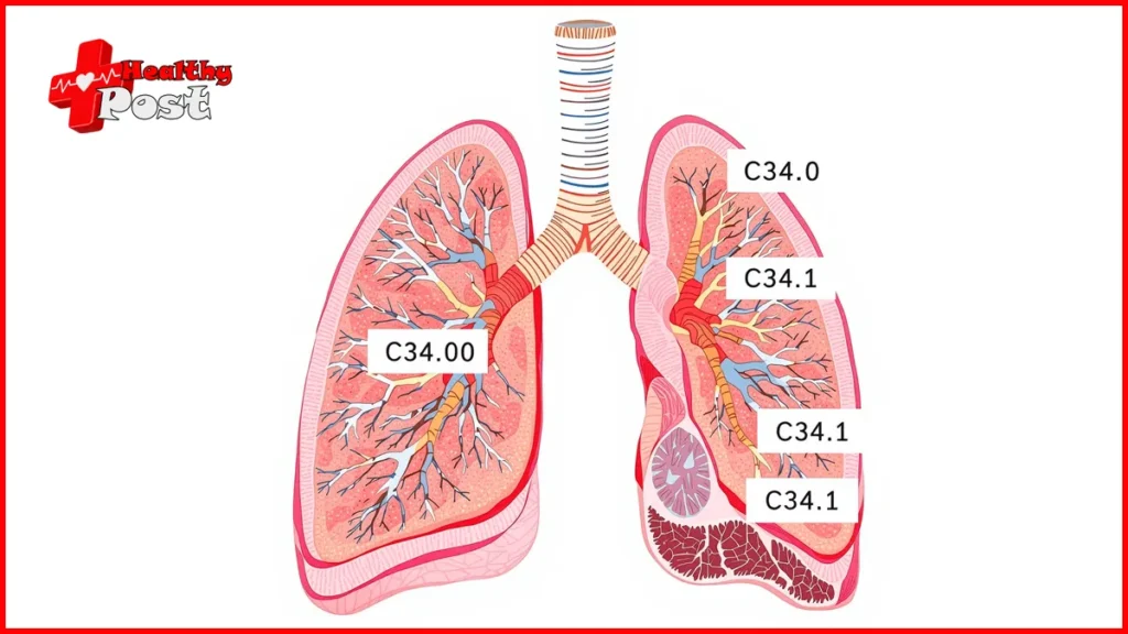 Lung Cancer ICD 10