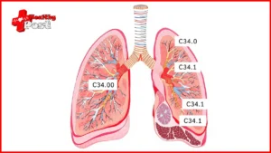 Lung Cancer ICD 10