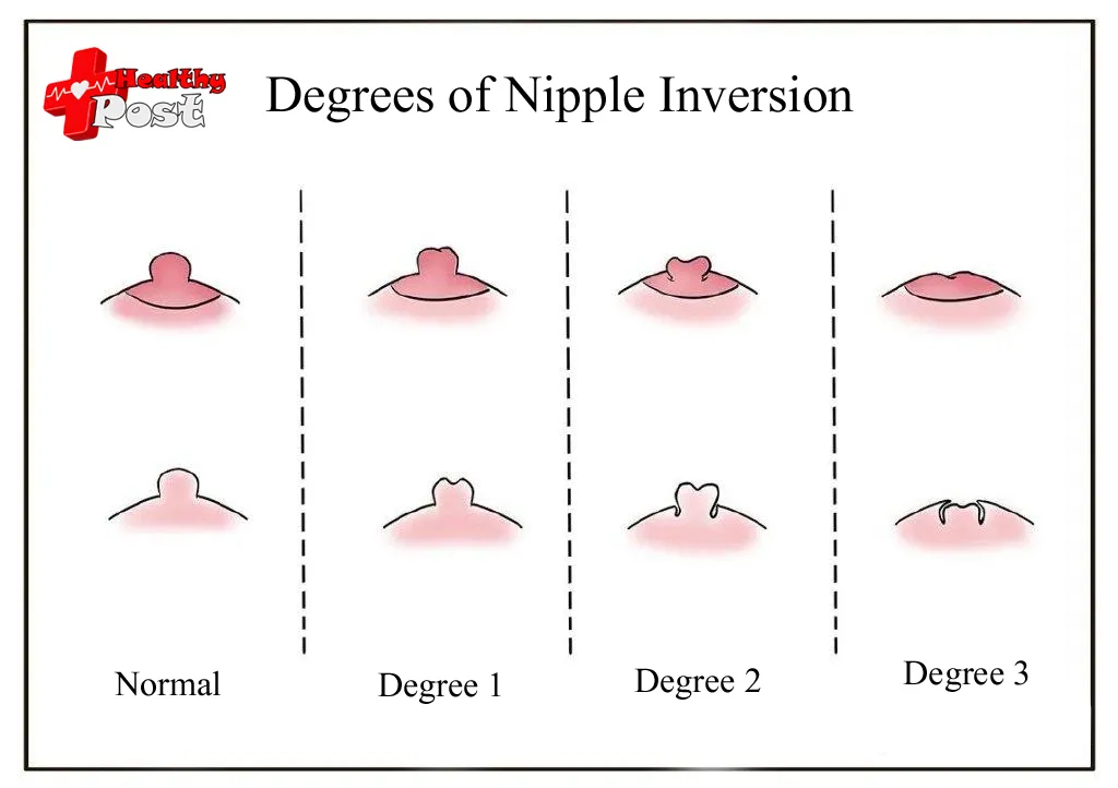 Degrees of nipple inversion