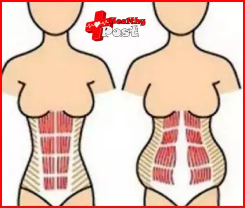 rectus abdominis separation